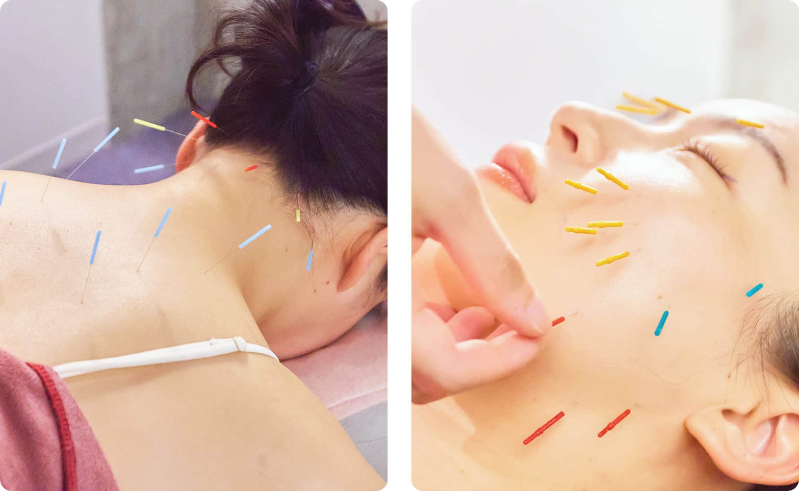 鍼灸治療